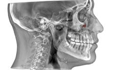 Lateral X-ray of a human skull showing teeth, cervical spine, and a red marker near the jaw joint area.
